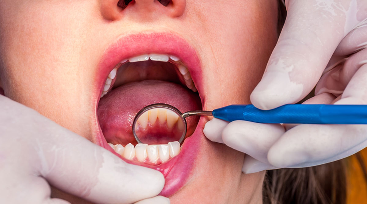 deep teeth cleaning