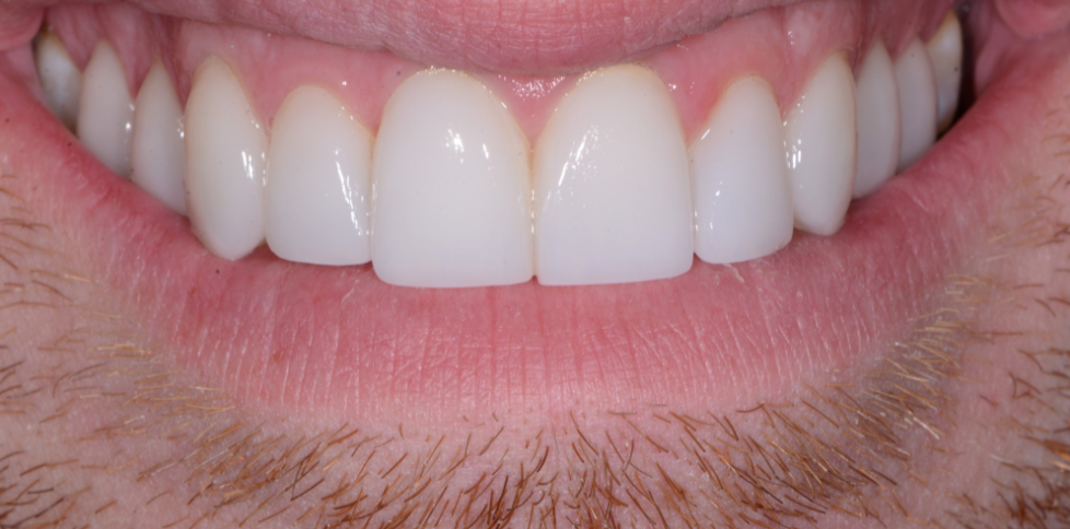 natural looking veneers