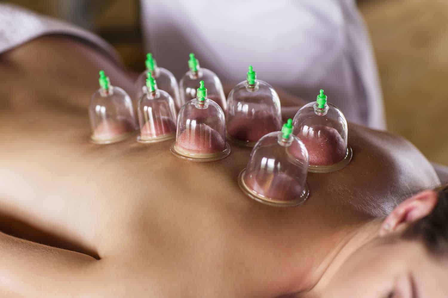 body cupping