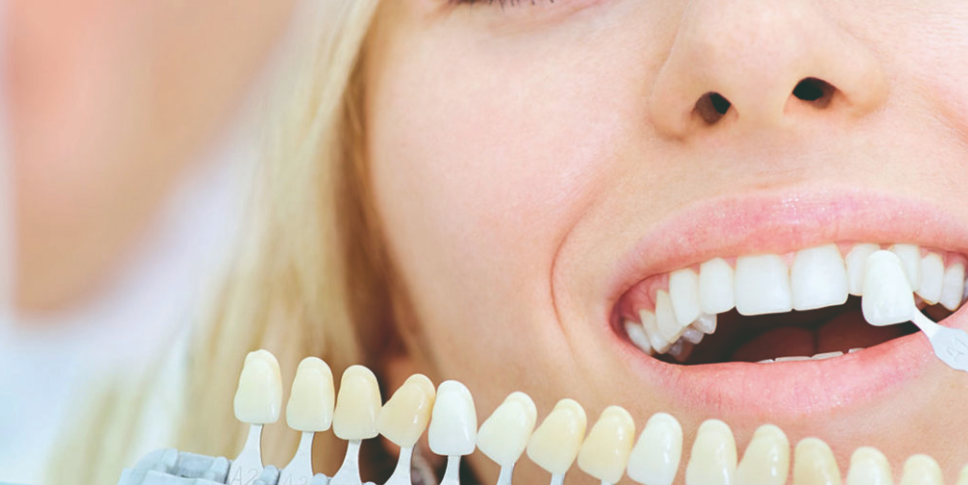 What Is The Procedure Of Dental Veneers Treatment?