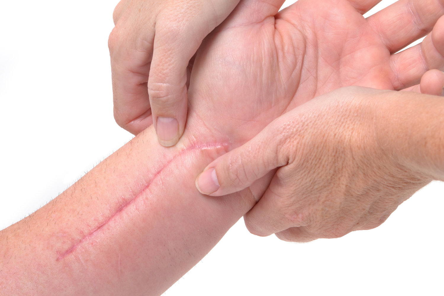 Get Scar Treatment In Brisbane To Maintain Skin And Cure Pain