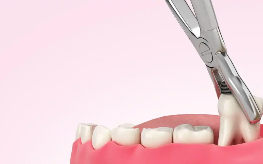 wisdom teeth removal cost